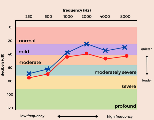 A chart showing regions of a hearing test that indicate normal, mild, moderate, moderately severe, severe or profound hearing loss. The x-axis shows frequency in hertz, and the y-axis shows decibels.